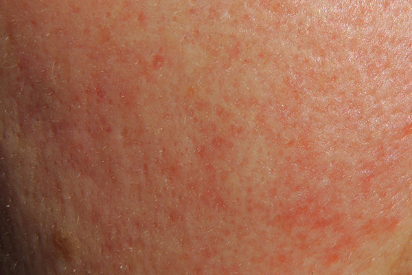 Les rougeurs sur le visage peuvent avoir de multiples causes