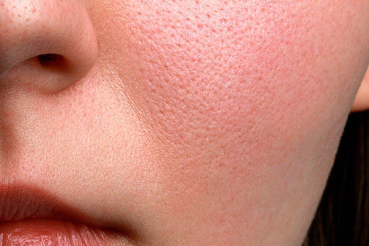 Les pores dilatés empêchent de garder une peau nette.