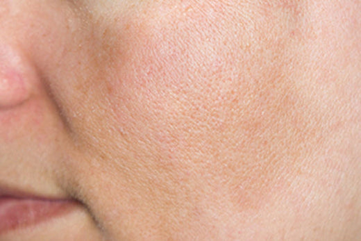 Masque de grossesse : FILORGA vous dit tout sur le mélasma.