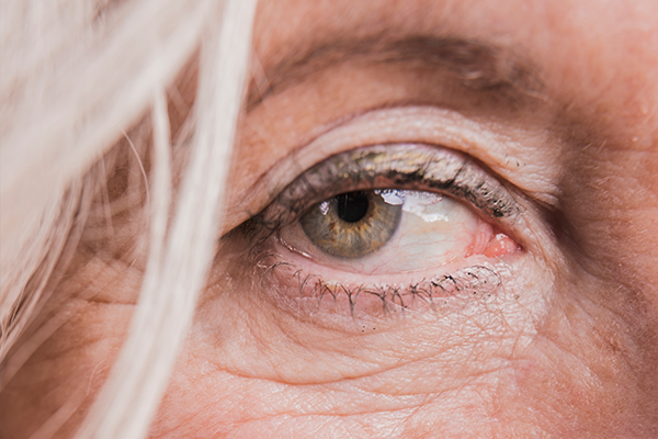 Le vieillissement de la peau se manifeste en premier sur le contour des yeux