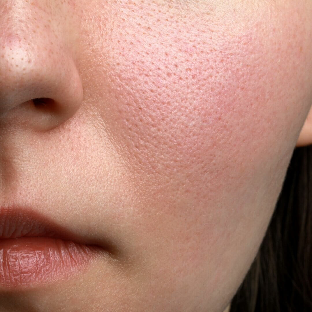 Les pores dilatés empêchent de garder une peau nette.